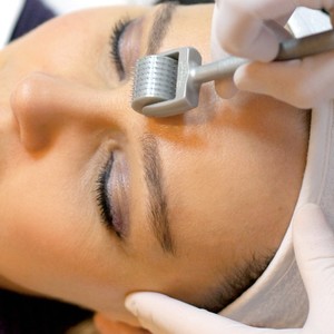 Microneedling