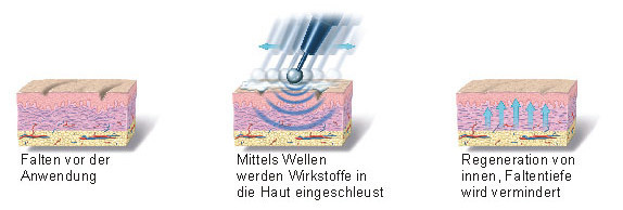 RF-Refacing