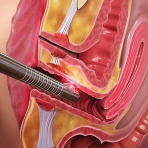 Vaginallaser Femilift